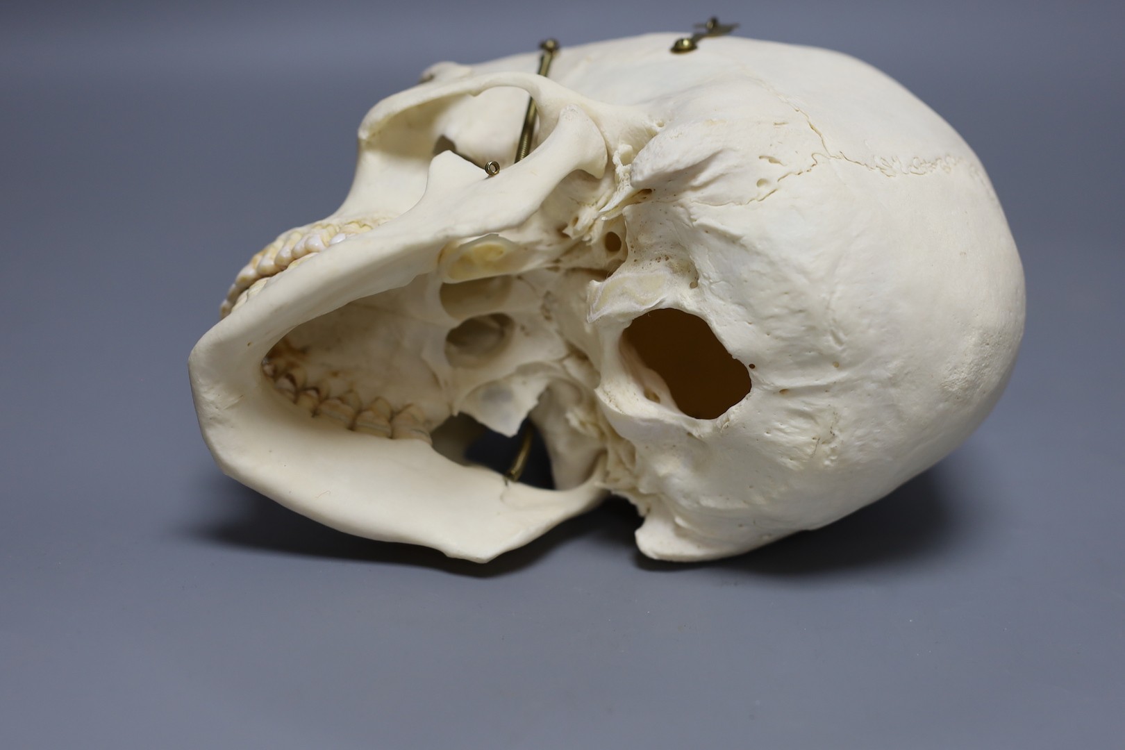 A human male skull, the vendor bought the item prior to 1977